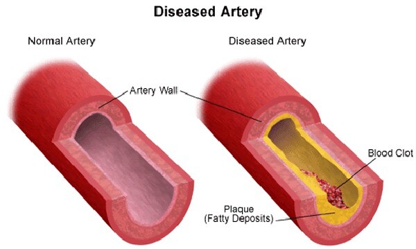 vasculardisease-diagram-veinsdiseasedartery