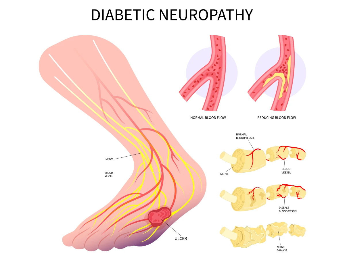 diabetic-neuropathy-1